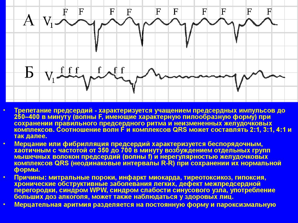 Трепетание предсердий. Трепетание предсердий частота. Типичное трепетание предсердий характеризуется частотой волн. Волны трепетания f. Правильная форма трепетания предсердий характеризуется.