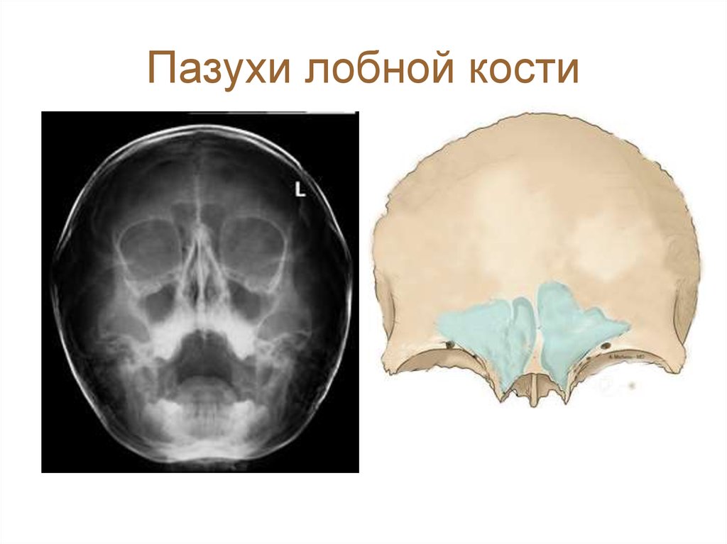Пазухи костей. Апертуры лобной пазухи анатомия. Лобная кость лобная пазуха. Анатомия лобной пазухи ЛОР.