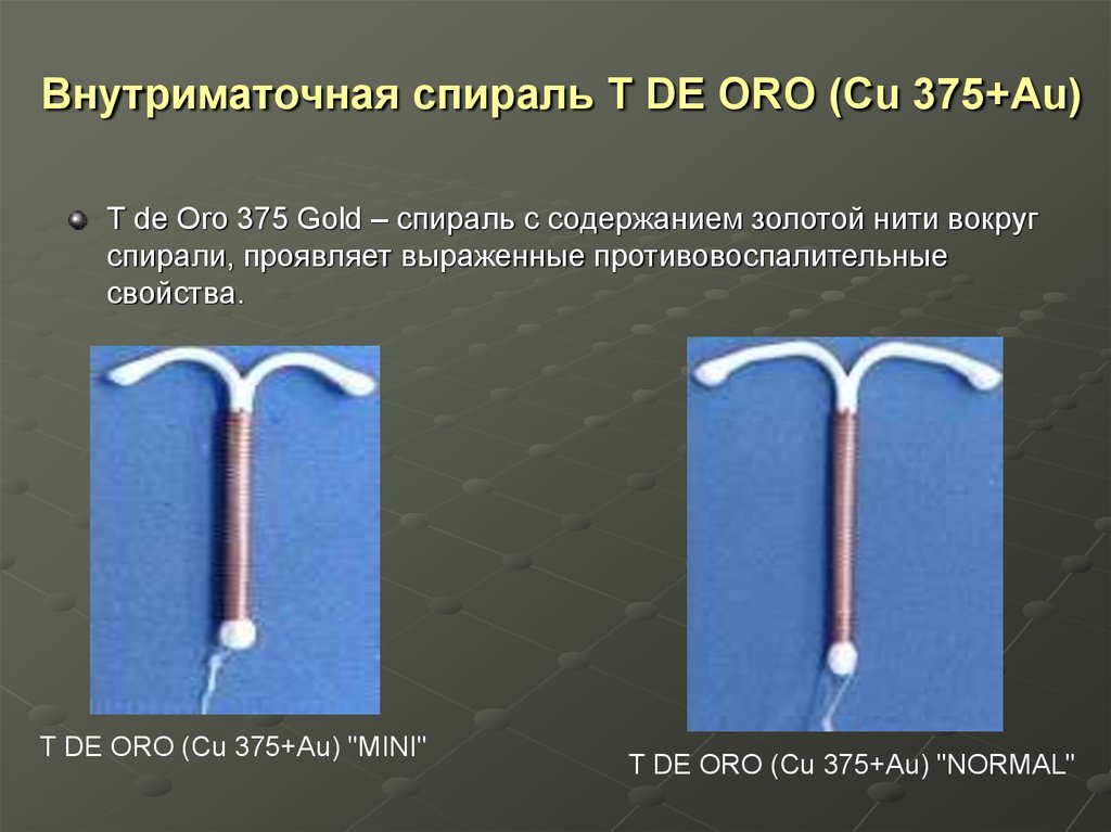 Вмс вводят. Спираль Мультилоад (Multiload cu-375). ВМС внутриматочная спираль. Т образная спираль внутриматочная. Медная спираль внутриматочная.