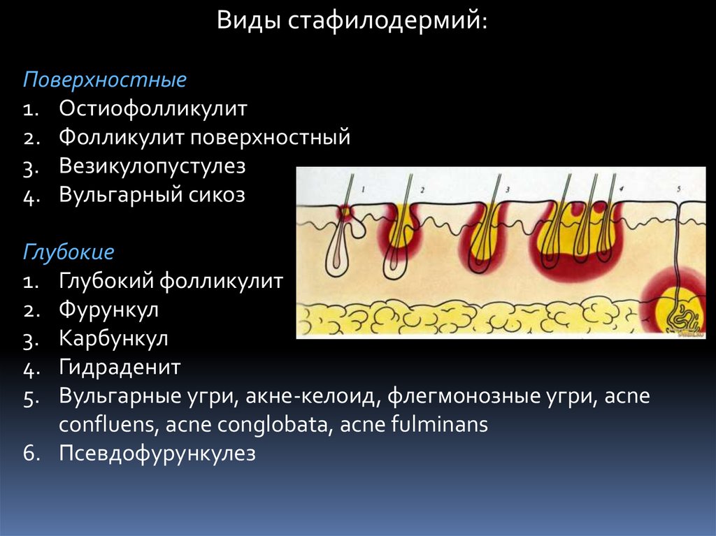 Фолликулит - причины, симптомы, диагностика, лечение в МЦ БОГОЛЮБЫ Луцк