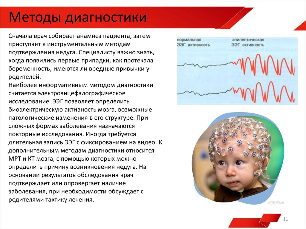 Возникновение эпилепсии у детей