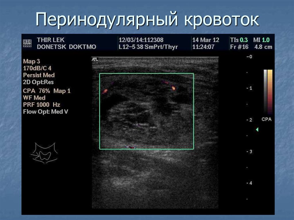 Усиление сосудистого рисунка щитовидной железы