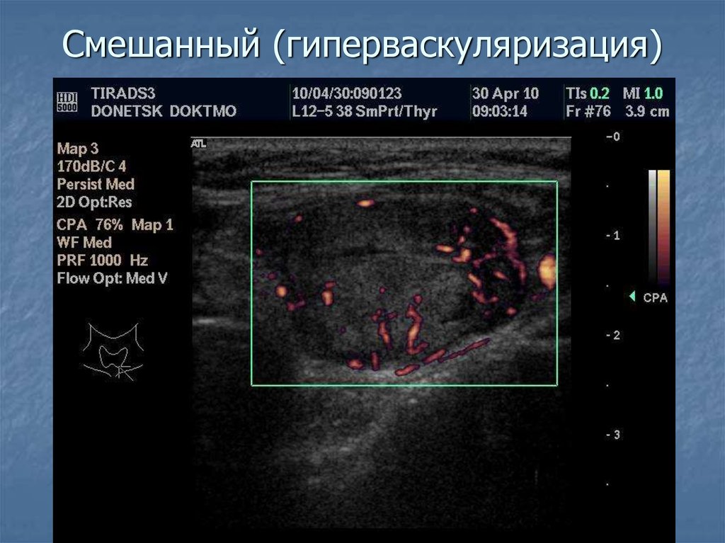 Пери интранодулярный