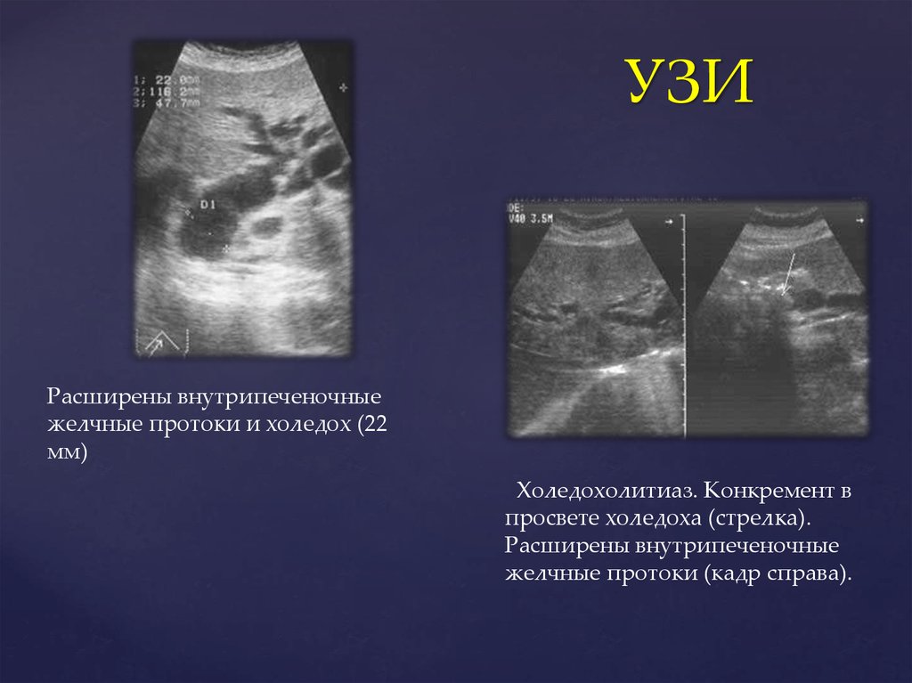 Расширение протоков печени. Расширение внутрипеченочных желчных протоков УЗИ. Расширение желчных протоков на УЗИ. Проксимальный отдел холедоха на УЗИ это. Холедох и желчный пузырь на УЗИ.