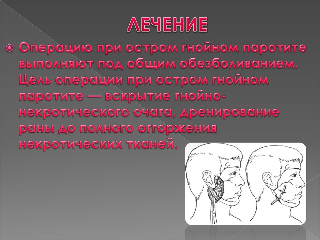 Цель операции. Операция при остром Гнойном паротите. Гнойный паротит операция. Вскрытие Гнойного паротита.