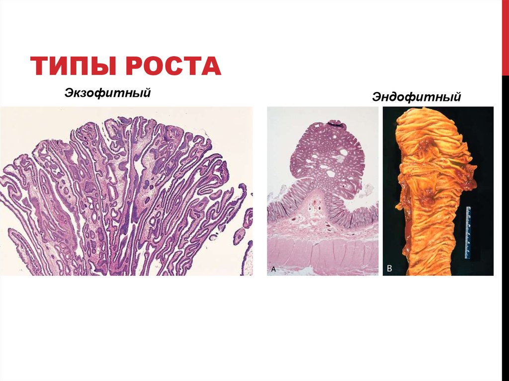 Экзофитный рост. Эндофитный рост опухоли. Экзофитный Тип роста опухоли. Вид опухоли эндофитный рост. Экспансивный Тип роста опухоли.