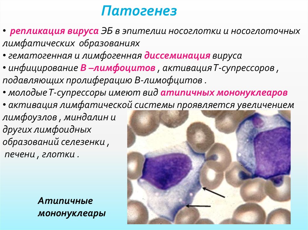 Инфекционный мононуклеоз вирус эпштейна