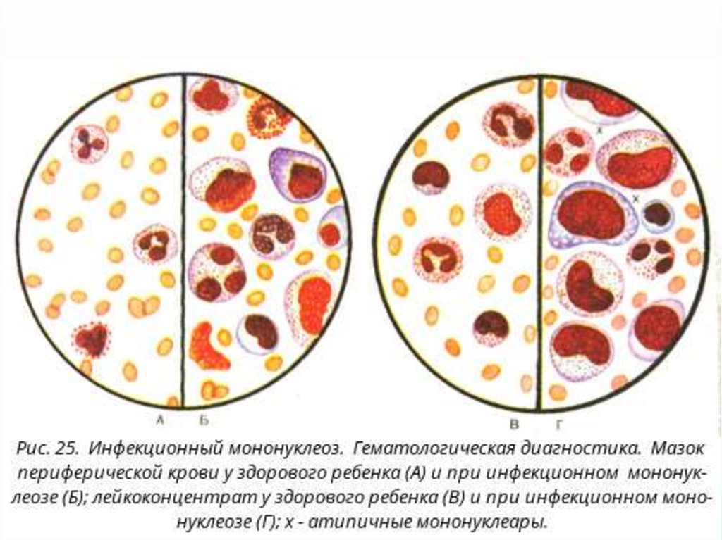 Диагноз инфекционный мононуклеоз