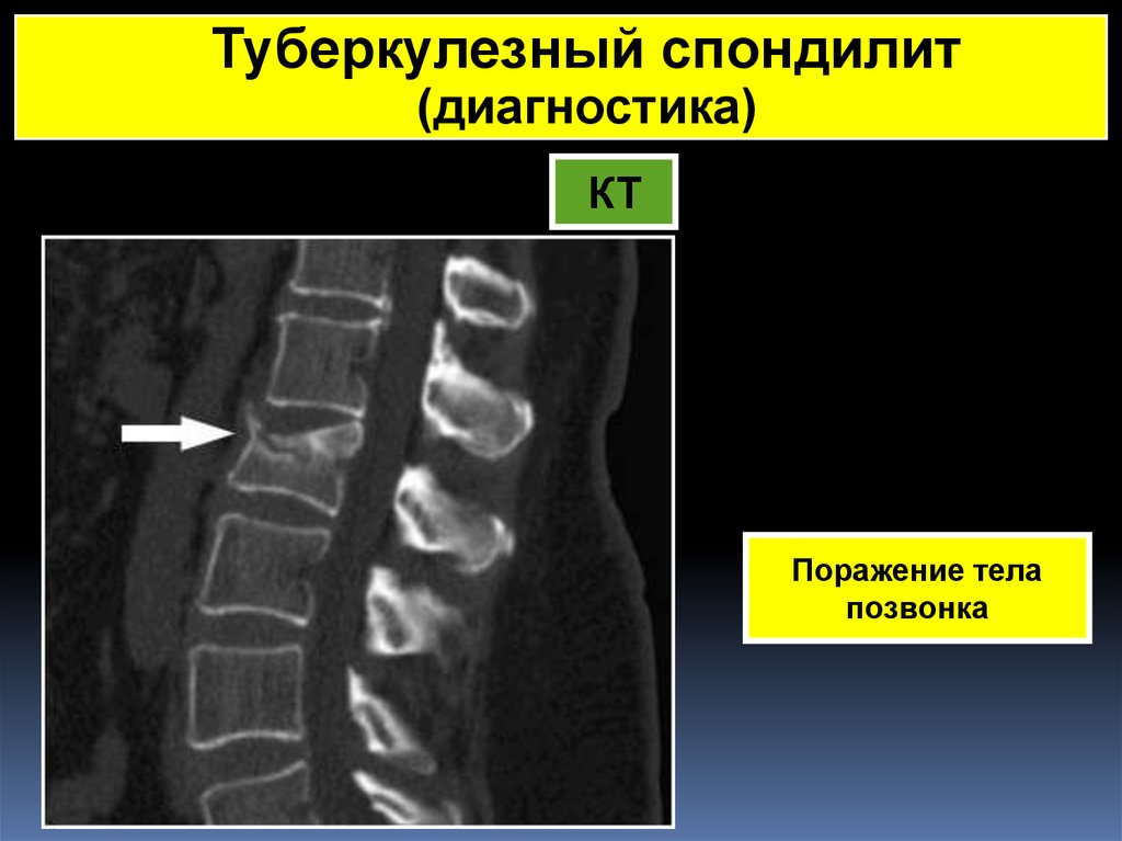 Спондилит это. Актиномикотический спондилит. Спондилит позвонков на кт. Хронический спондилит. Спондилит позвоночника на кт.