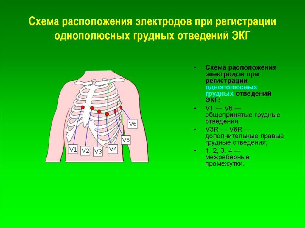 Экг 6. ЭКГ электроды v1-v6. При записи ЭКГ грудной v5 электрод располагается по левой. Для записи ЭКГ v6 активный электрод располагают. При записи ЭКГ грудной v3 электрод располагается:.