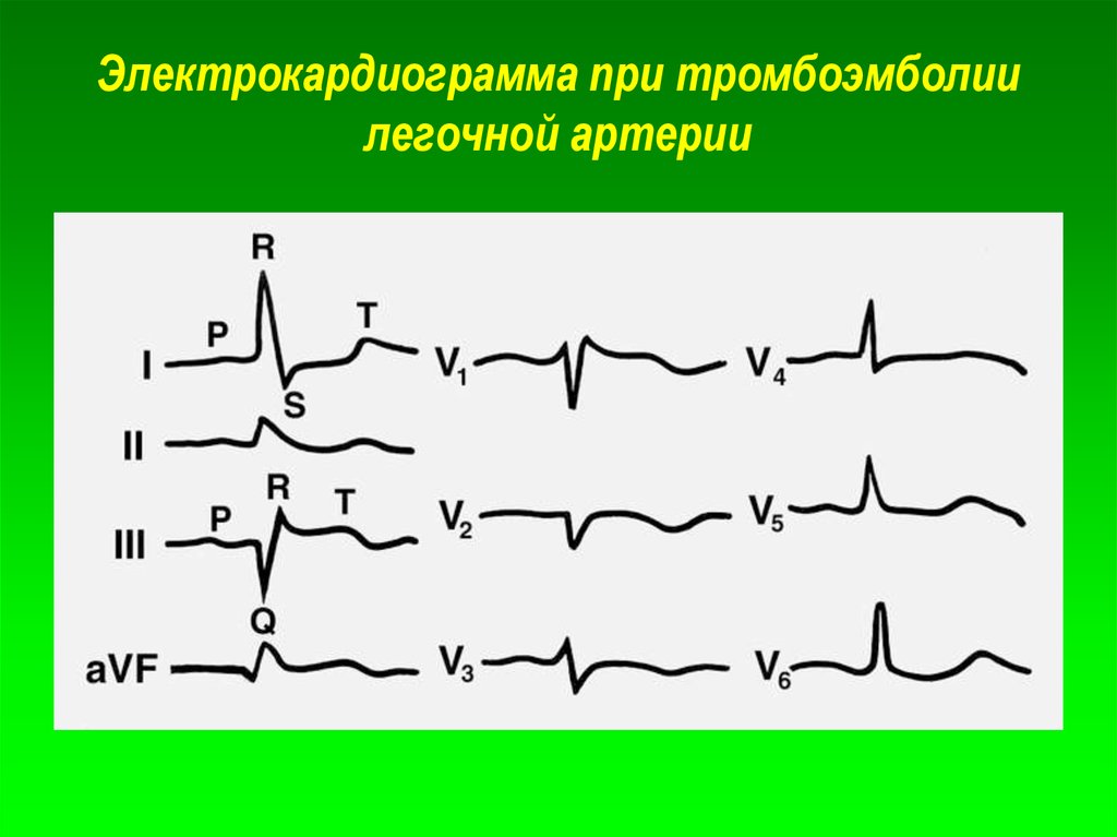Тромбоэмболия легочной артерии экг. ЭКГ. Электрокардиограмма при тромбоэмболии легочной артерии. Методика записи ЭКГ. ЭКГ при тромбоэмболии легочной артерии.