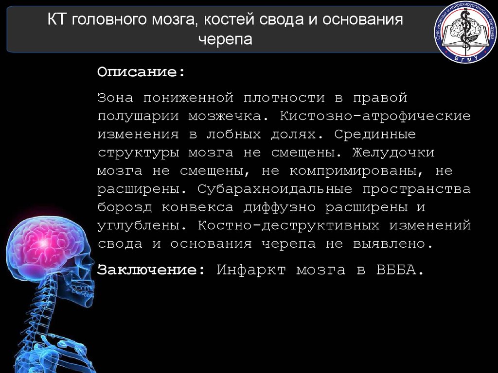 До мозгов костей. Срединные структура мозга не смещены. Срединные структуры мозга. Кт костей черепа заключение. Презентация загадки головного мозга.