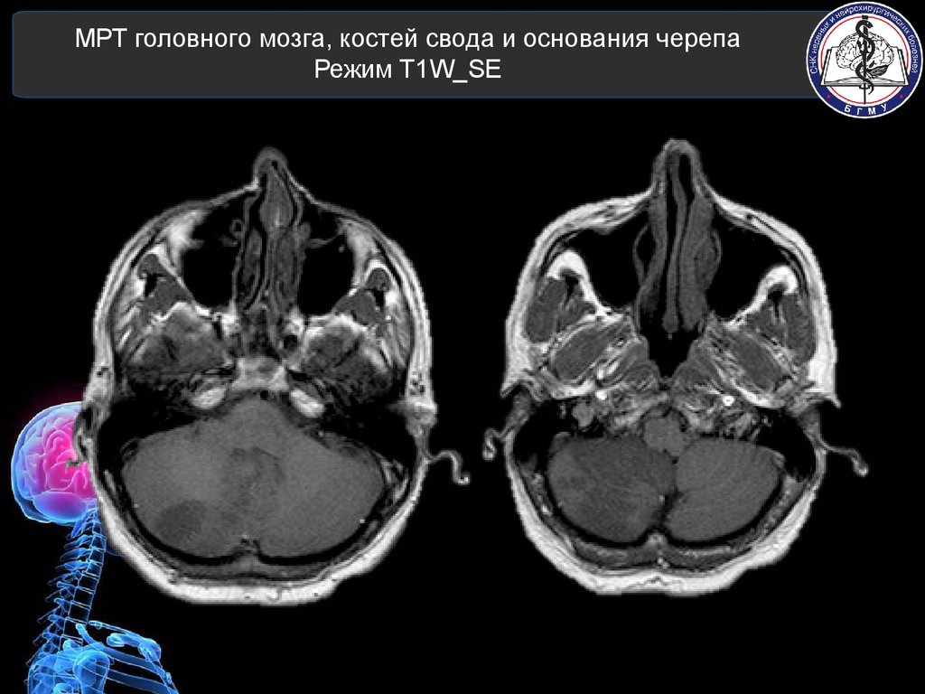 Кт лицевых костей. Компьютерная томография черепа.