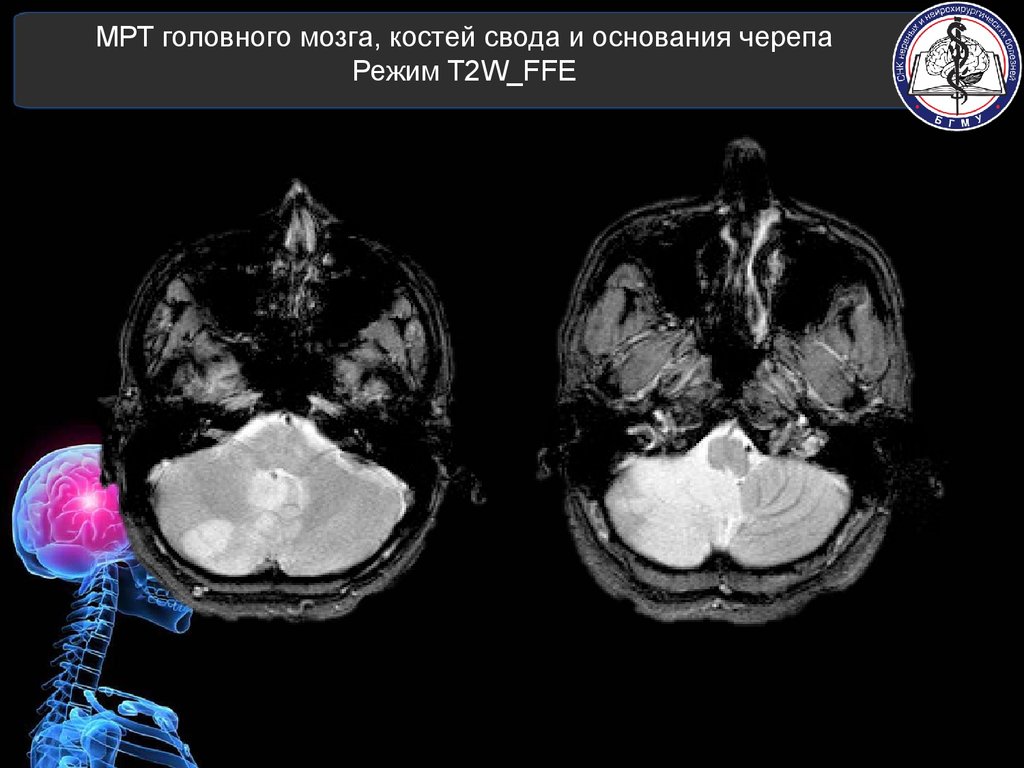 Мрт 9. Кт головного мозга и костей черепа. Мрт головного мозга кости головы.