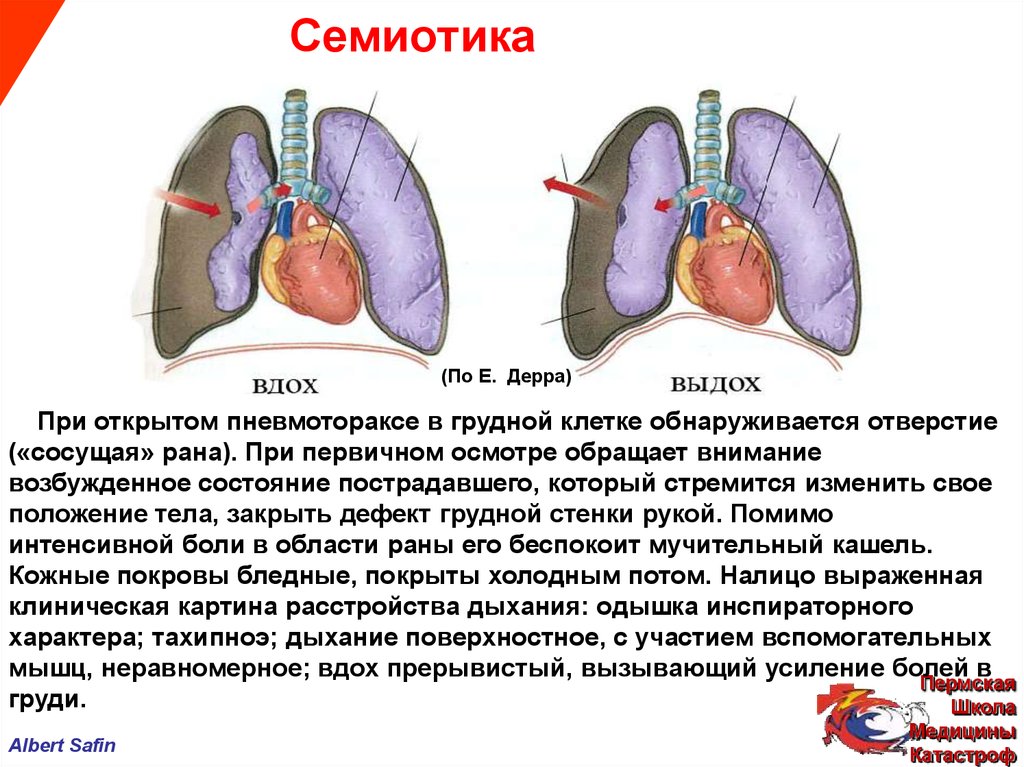 Боли при полном вдохе