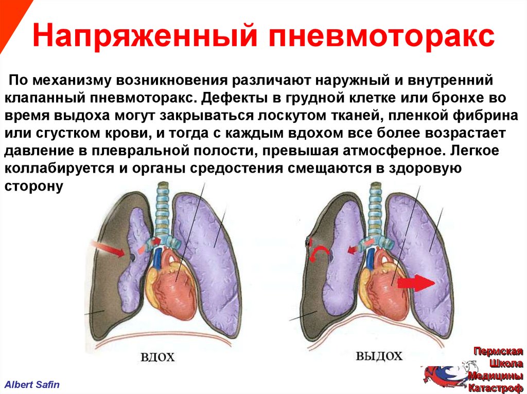 Клапанный пневмоторакс презентация