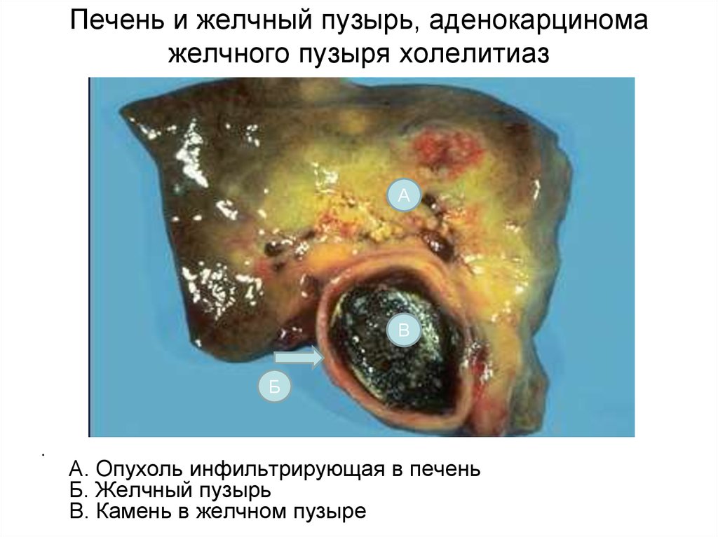 Стол при болезни желчного пузыря