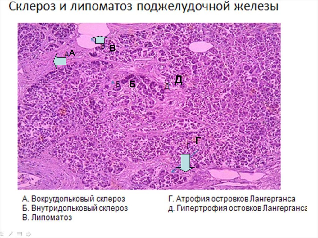 Фиброз железы. Поджелудочная железа при диабете микропрепарат. Липоматоз поджелудочной железы гистология. Поджелудочная железа при СД микропрепарат патанатомия. Поджелудочная железа при диабетической фетопатии микропрепарат.