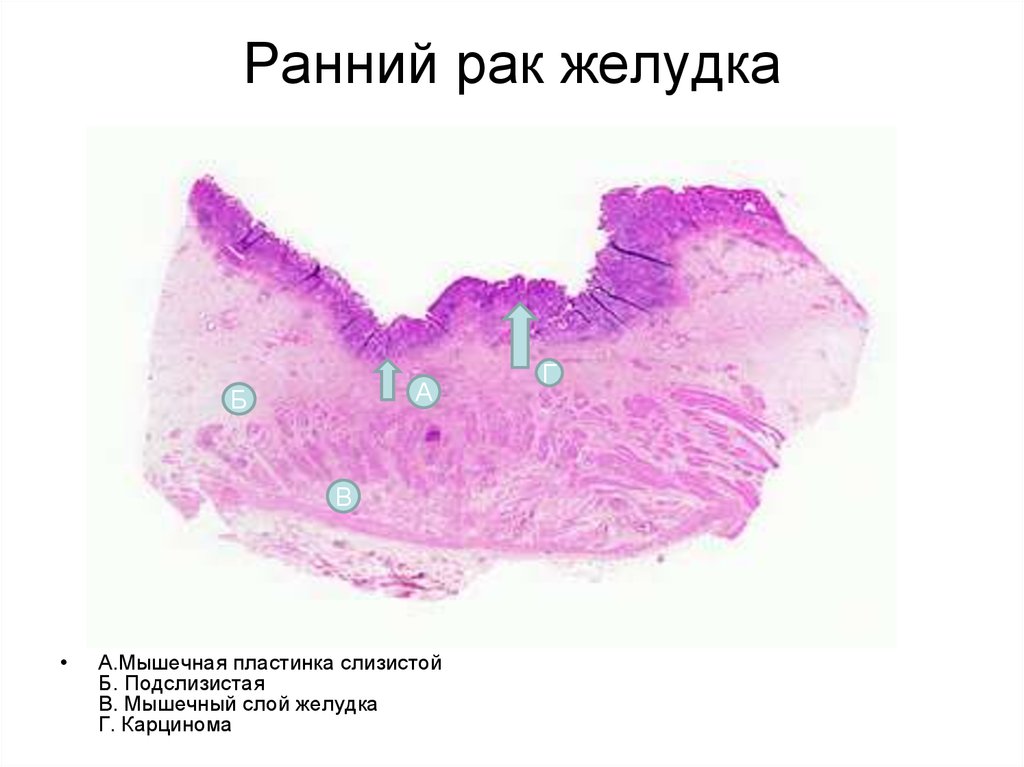 Рак желудка на ранней стадии. Понятие «ранний рак» подразумевает.