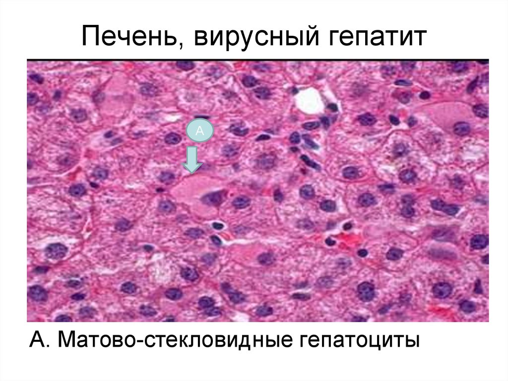 Клетки печени разрушаются. Гепатоциты гистология. Гепатит печени патанатомия. Вирусный гепатит гистология. Матовостекловидные гепатоциты.