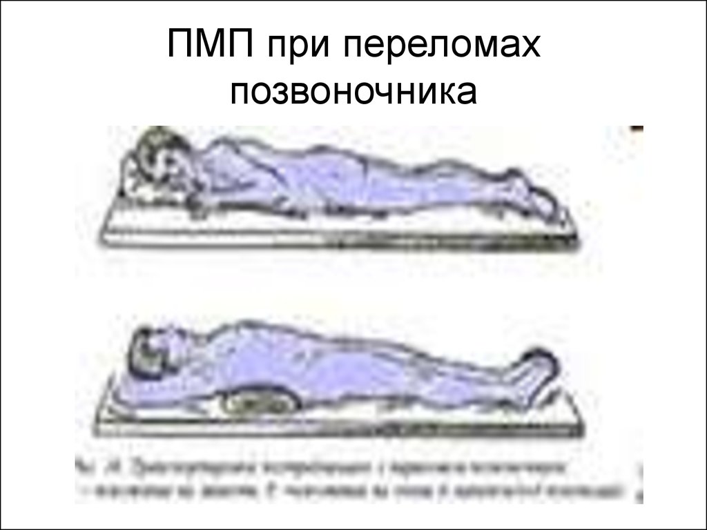 Первая помощь при позвоночнике. Первая медицинская помощь при переломе позвоночника. ПМП при переломе позвоночника. ПМП при переломе позвонка. ПМ при переломе позвоночника.