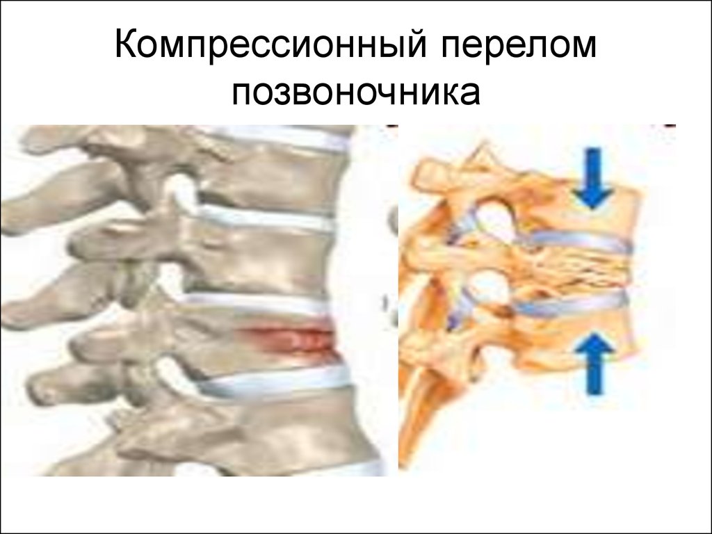 Компрессионный позвоночник. Компрессионный механизм повреждения позвоночника. Компрессионный перелом с4 с5. Компрессионный перелом позвоночника т11. Компрессионный перелом тел с5 с6 позвонков.