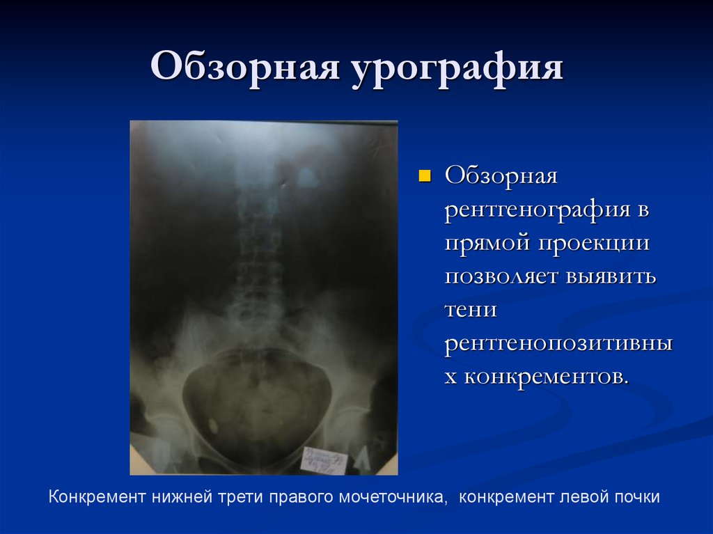 Урография. Обзорная рентгенография почек урография. Мочеточники урография рентген. Обзорная урограмма почек рентген. Обзорная урограмма при мкб.