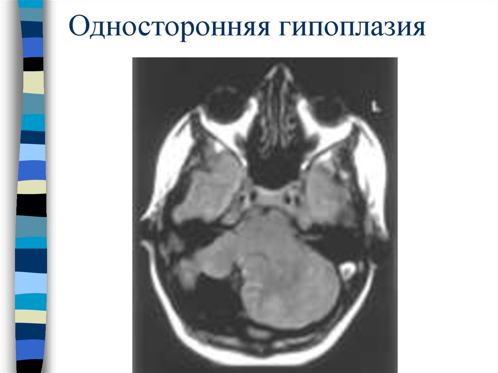 Гипоплазия легкого презентация