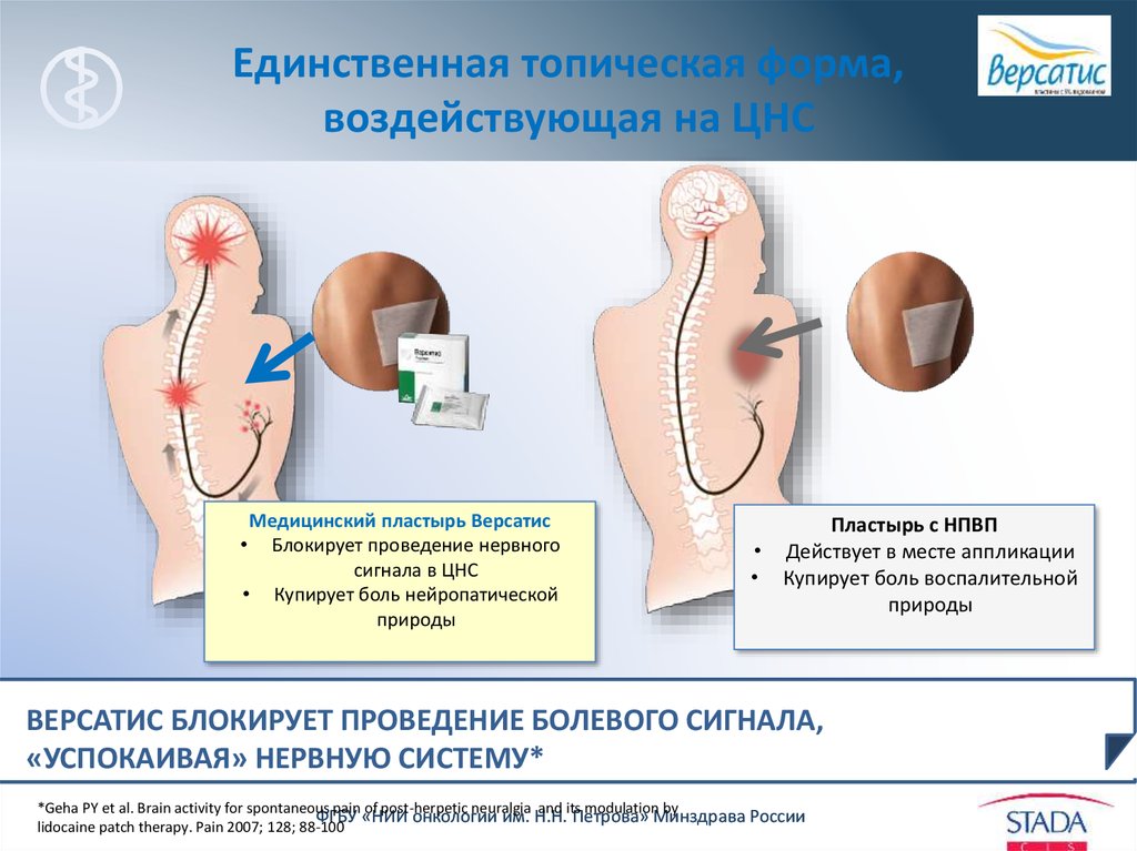 Версатис пластырь отзывы пациентов