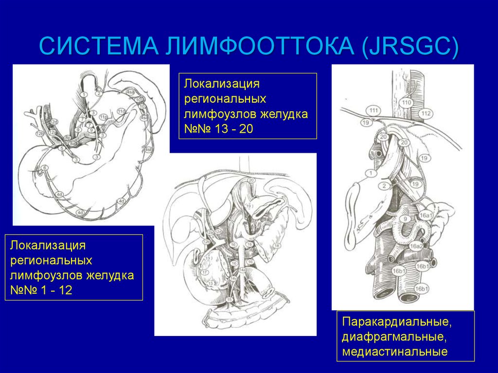 Лимфатические узлы желудка схема