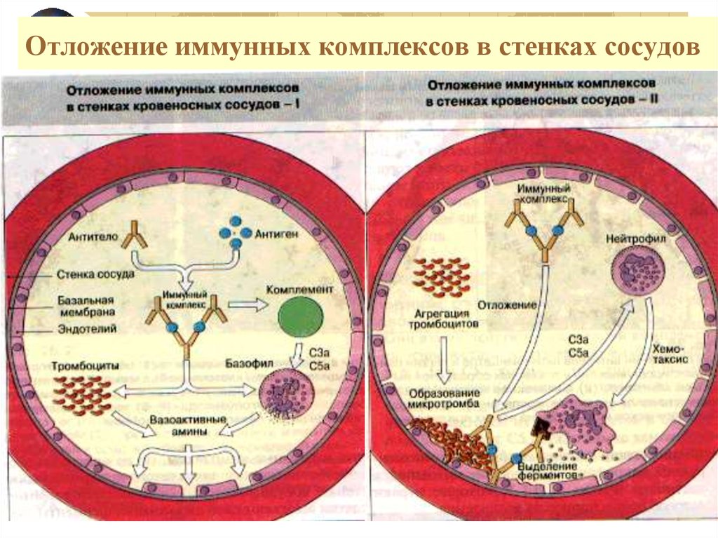 Иммун комплекс. Механизмы элиминации иммунных комплексов. Отложение иммунных комплексов. Иммунный комплекс на сосуде. Схема образования иммунных комплексов.