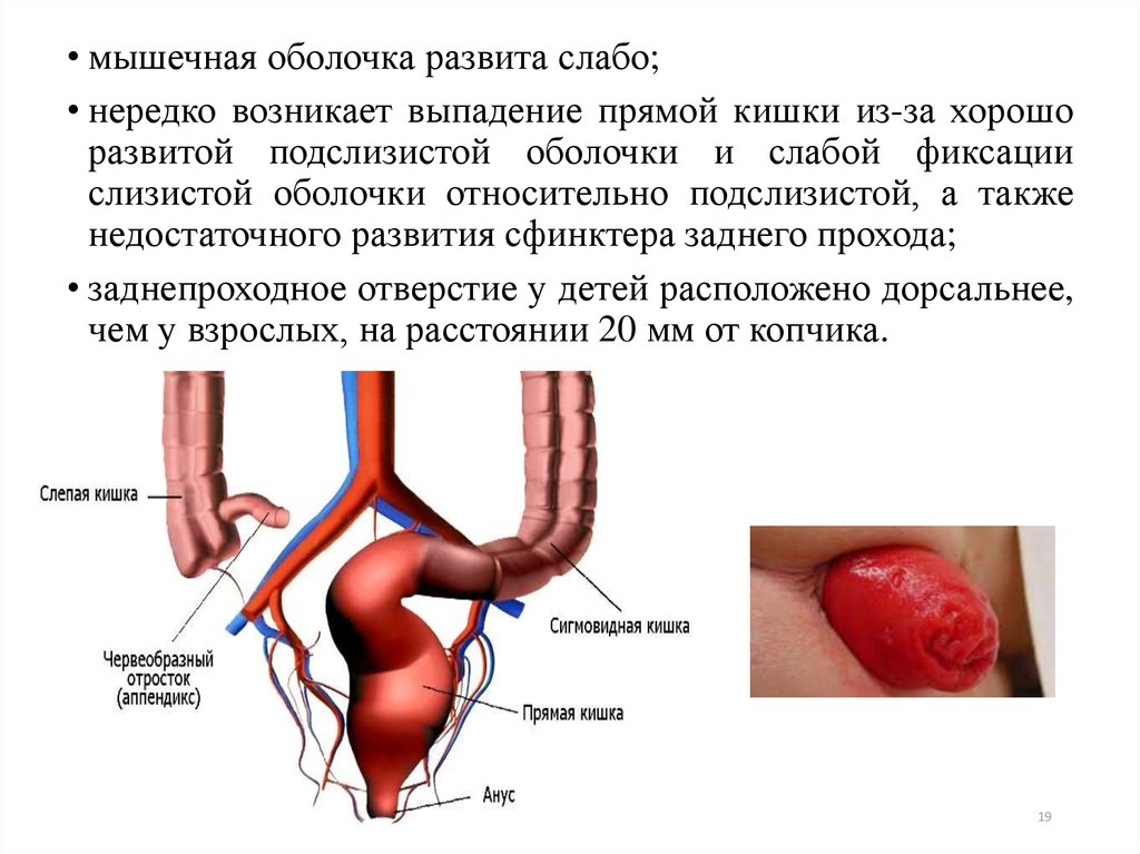 Выпадение прямой кишки при дефекации. Выпадение прямой кишки кишки. Выпадение слизистой оболочки прямой кишки. Выпадение сфинктера прямой кишки.