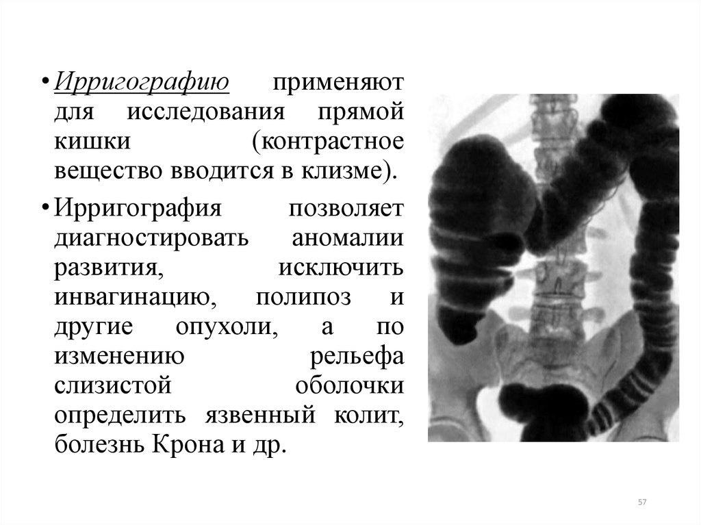 Ирригография. Исследование прямой кишки. Ирригография прямой кишки. Ирригография контрастное вещество. Контрастное исследование прямой кишки.