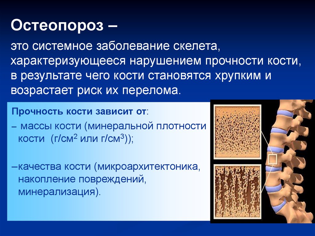 Заболевание костей. Остеопороз. Системные заболевания костей. Остеопороз презентация.