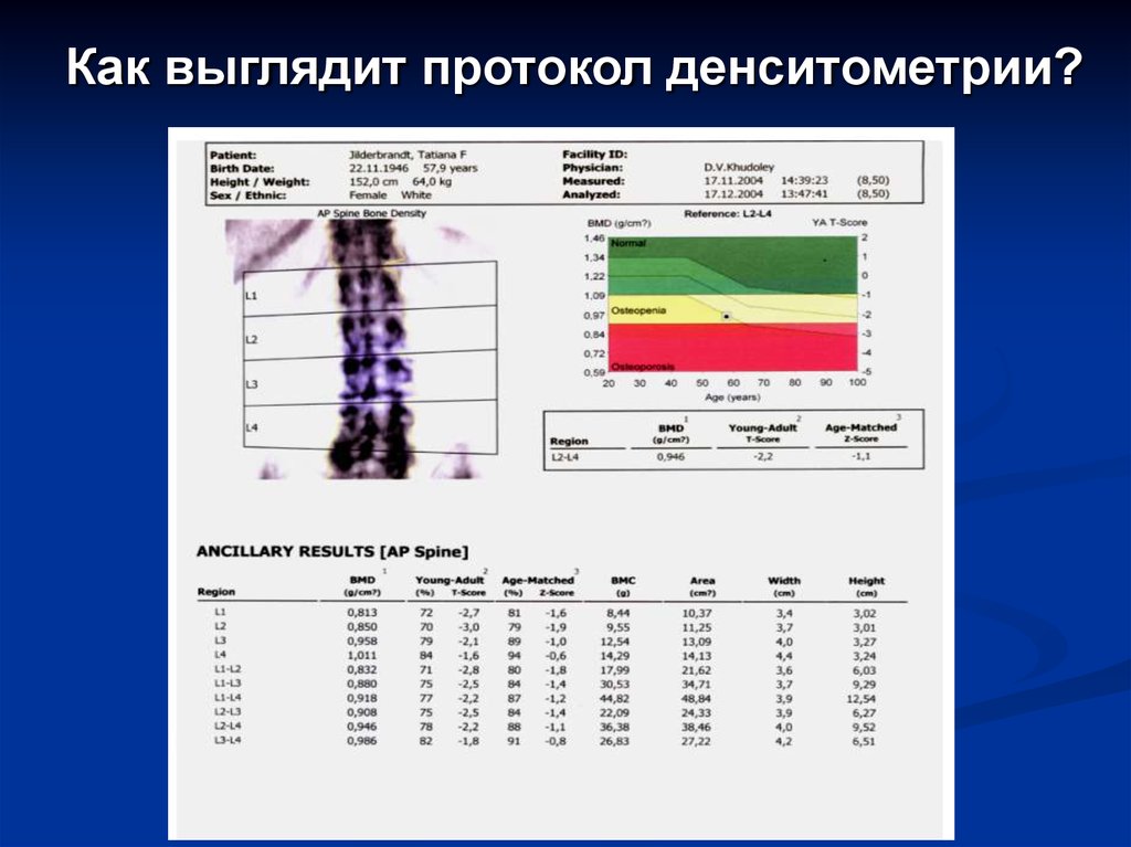 Направление на денситометрию образец заполнения