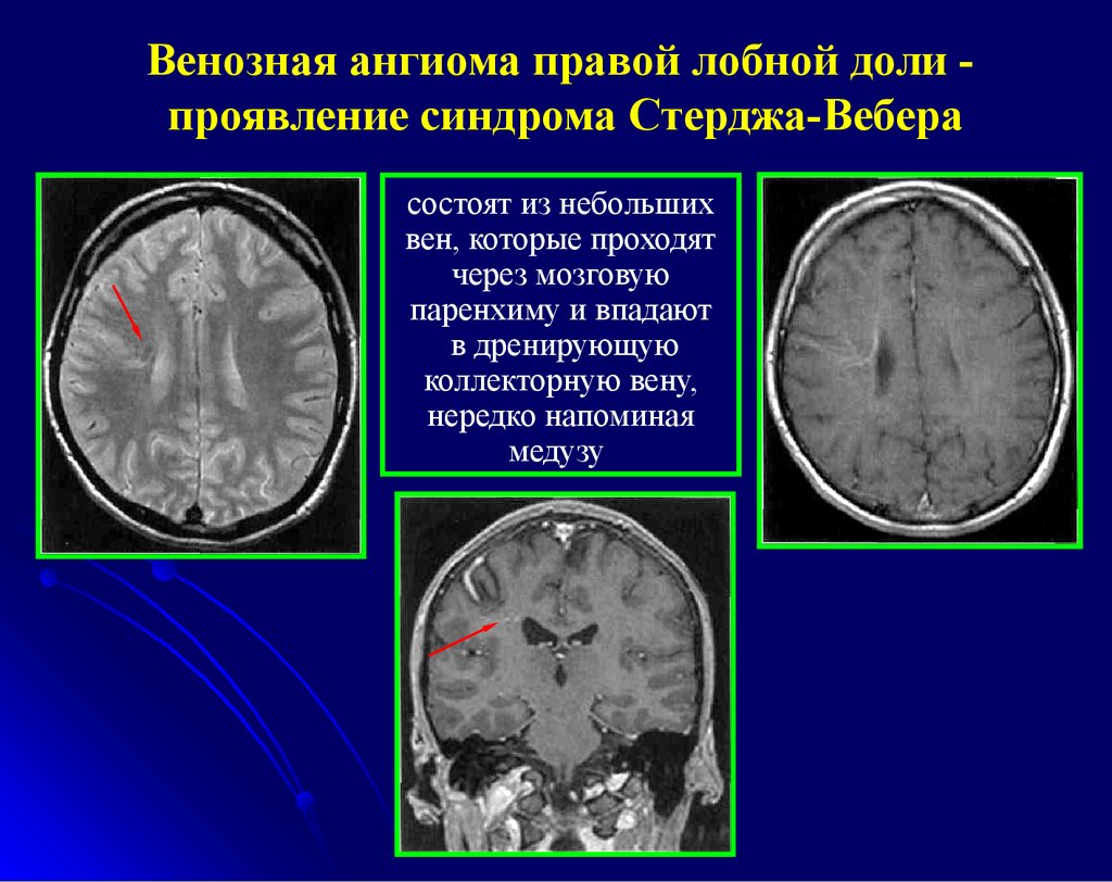 Образование в лобной доле. Гроздьевидная ангиома. Ангиома головного мозга кт. Сосудистая мальформация головного мозга на кт. Венозная мальформация головного мозга кт.