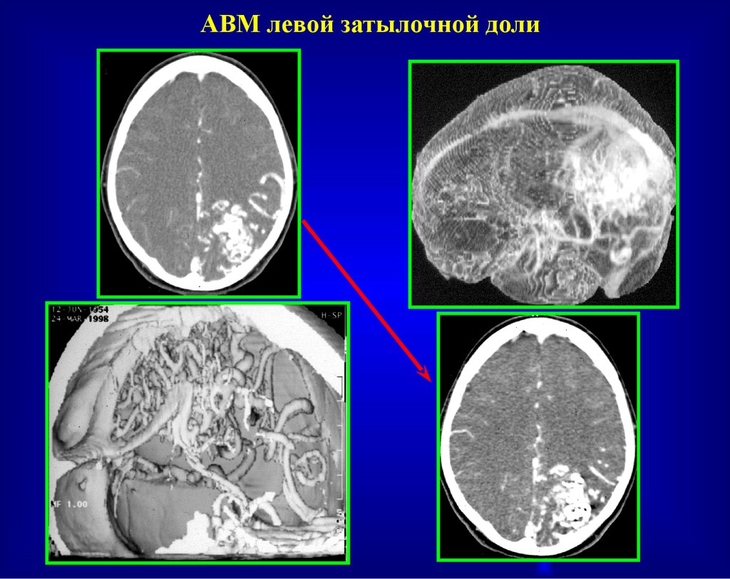 Сосудистые мальформации головного. АВМ мальформация сосудов головного мозга. Артериовенозная мальформация ГМ. Сосудистая мальформация головного мозга на кт. Артериовенозная мальформация головного мозга мрт.