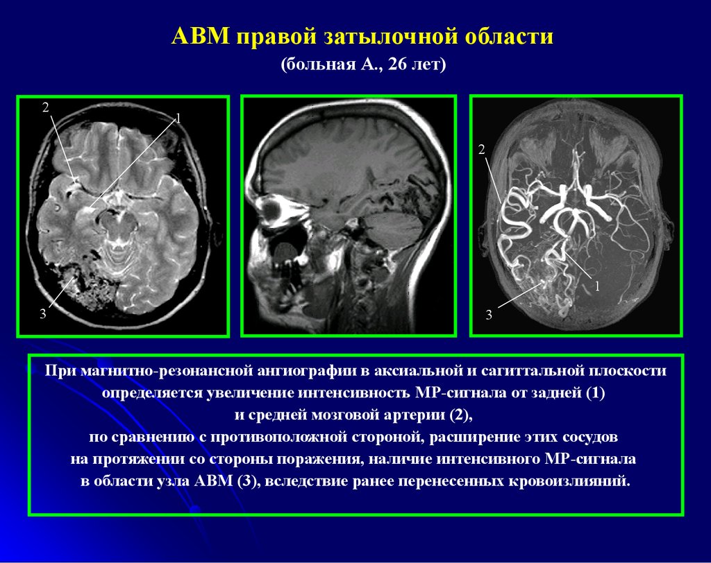 Сосудистая аномалия. Артериовенозная мальформация сосудов головного мозга на кт. Артериовенозная мальформация головного мозга мрт. Артериовенозная мальформация на кт головы. Мальформация на кт головного мозга.
