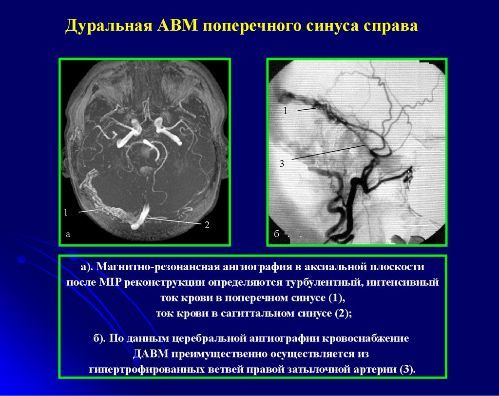 Гипоплазия правого поперечного синуса. Сосудистые мальформации кт мрт. Мальформация сосудов головного мозга кт. Артериовенозные мальформации сосудов головного мозга кт. Артериовенозная мальформация сосудов головного мозга мрт.