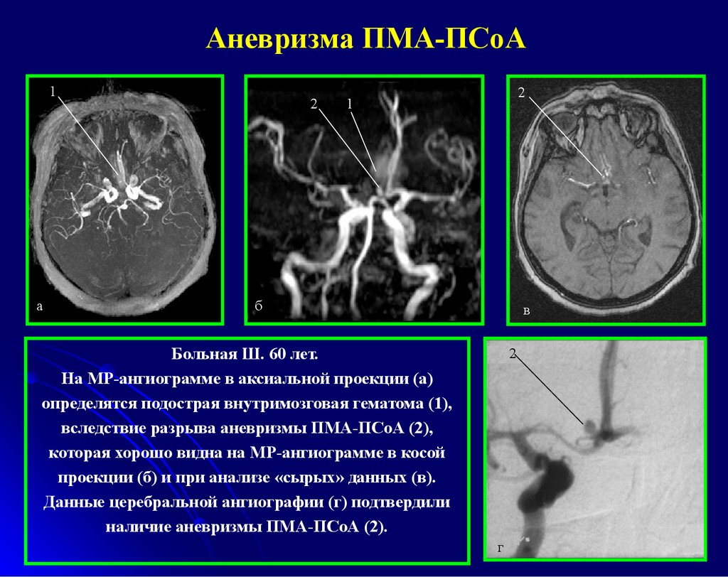 Аневризма галена. Аневризма мозговых артерий кт. Аневризма ПМА кт головного мозга. Аневризма артерии головного мозга на мрт. Аневризма сосудов головного мозга кт.