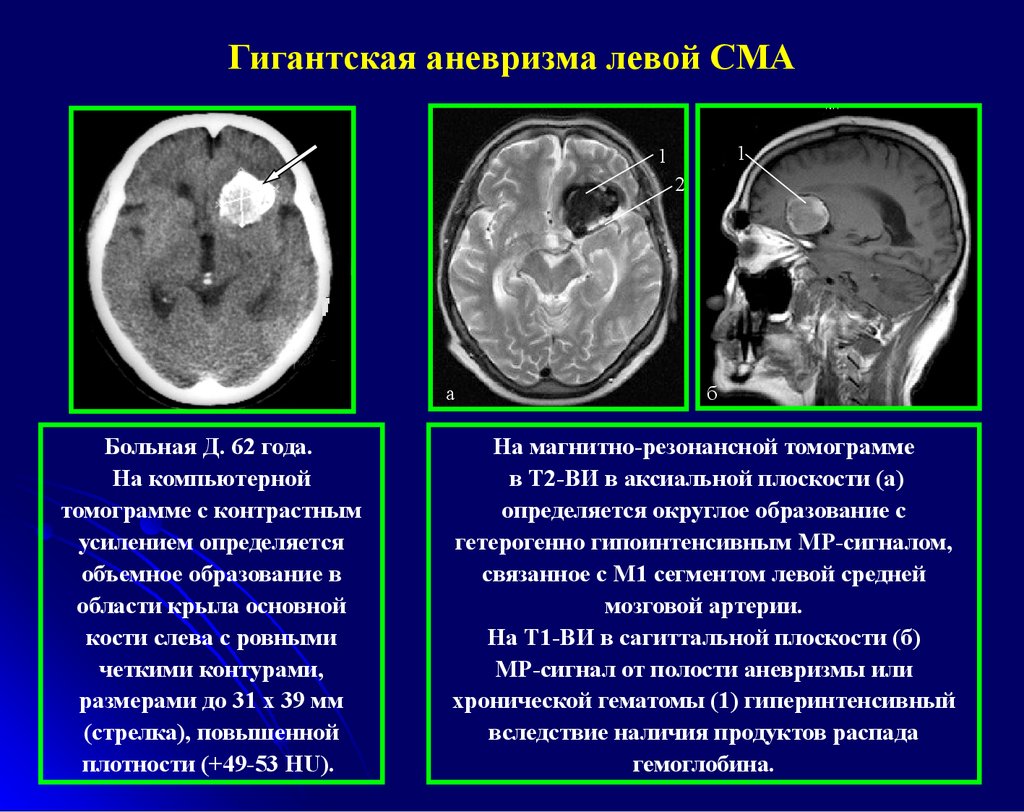 Форум аневризма мозга. Аневризма сосудов головного мозга кт. Аневризма средней мозговой артерии кт. Сосудистые мальформации кт мрт. Аневризма кт или мрт головного мозга.