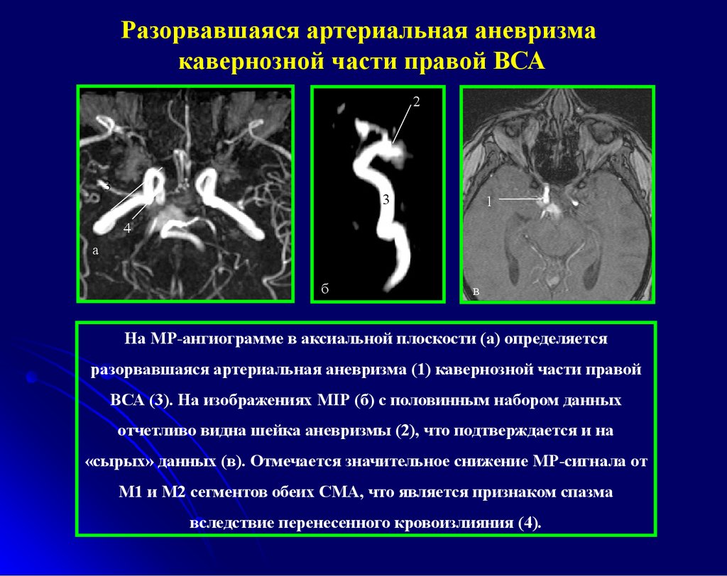 Сегменты внутренней сонной артерии схема мрт