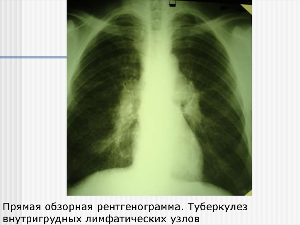 Внутригрудные лимфатические узлы. Туберкулез лимфатических узлов рентгенограмма. Туберкулез внутригрудных лимфоузлов рентгенограмма. Туберкулез внутригрудных лимфатических узлов рентген. Туберкулез лимфоузлов легких рентген.