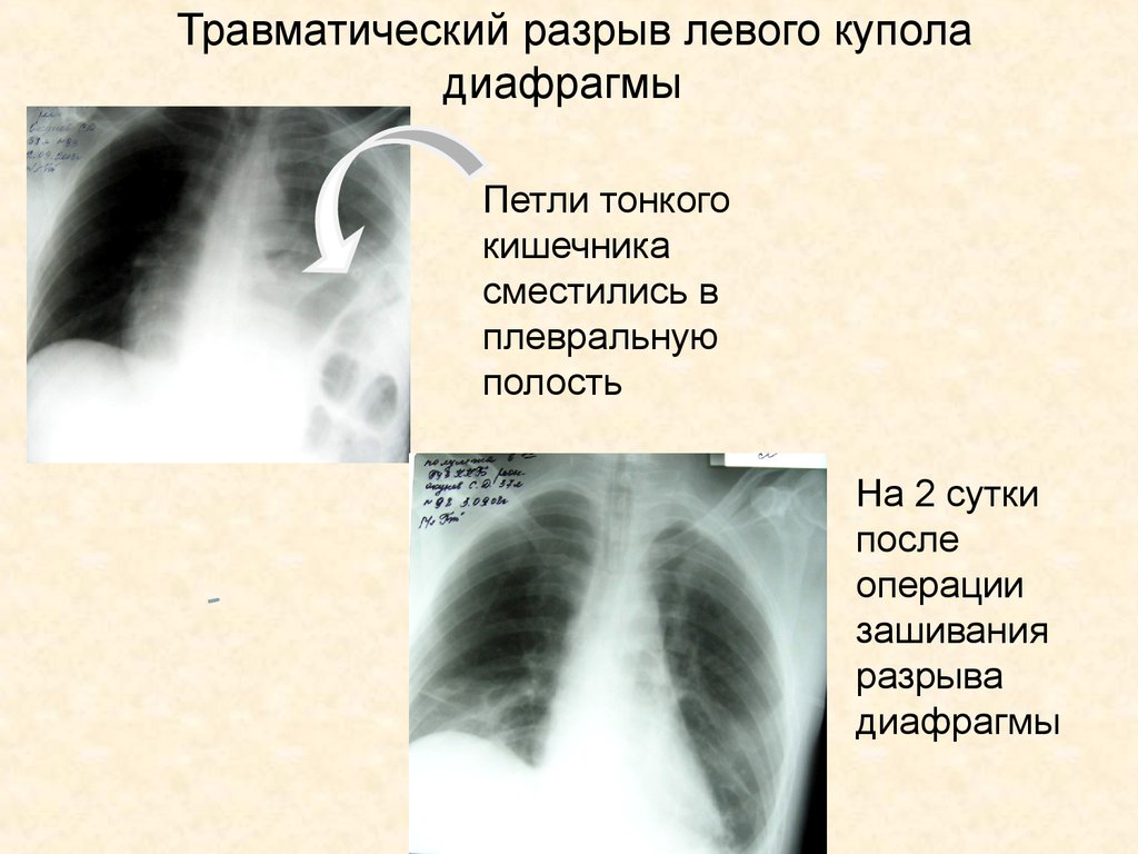 Симптом диафрагмы. Разрыв левого купола диафрагмы. Петли кишечника под левым куполом диафрагмы рентген. Травма диафрагмы рентген. Травматический разрыв диафрагмы.