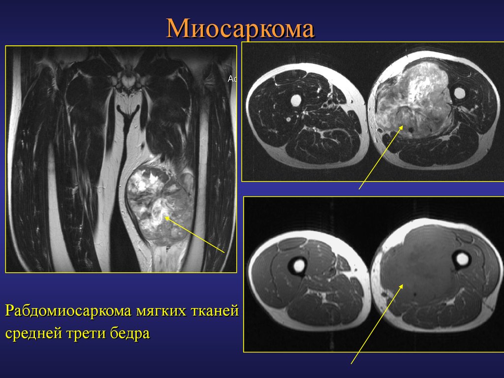 Саркома кт. Саркома мягких тканей бедра мрт. Липосаркома паранефральной клетчатки.