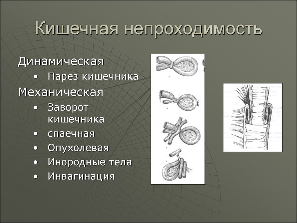 Парез кишечника лечение