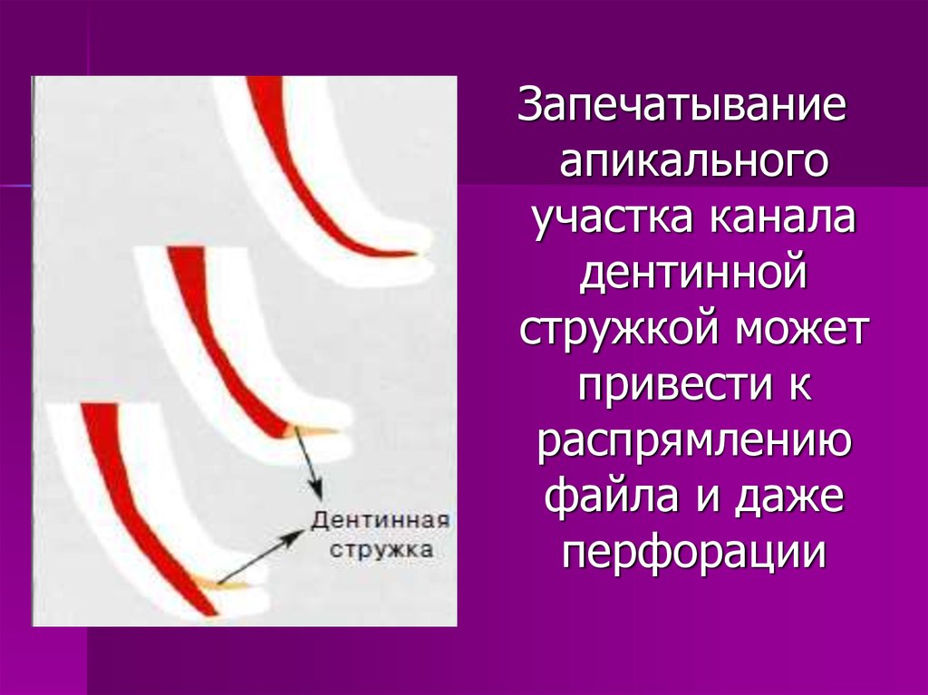 Трети корневого канала. Апикальная треть корневого канала. Апикально корональные методы обработки корневых каналов. Транспортация корневого кала. Апикальное расширение корневого канала.