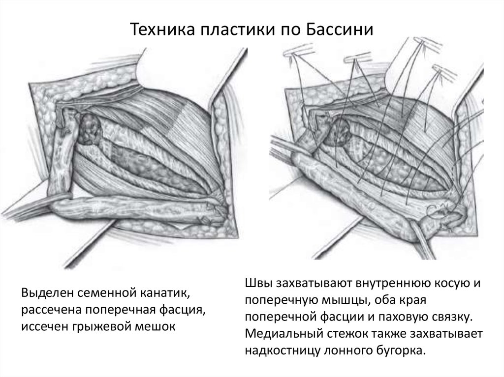 Рассол капусты при паховой грыже