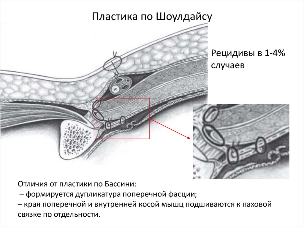 Пластика грыж. Шолдайсу грыжесечение. Пластика паховой грыжи по Шоулдайс. Паховая грыжа пластика по Шолдайсу. Шолдайс пластика грыжи.