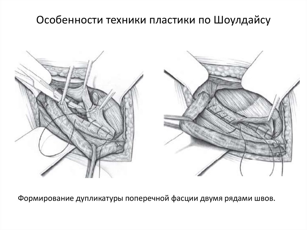 Пахово мошоночная грыжа фото